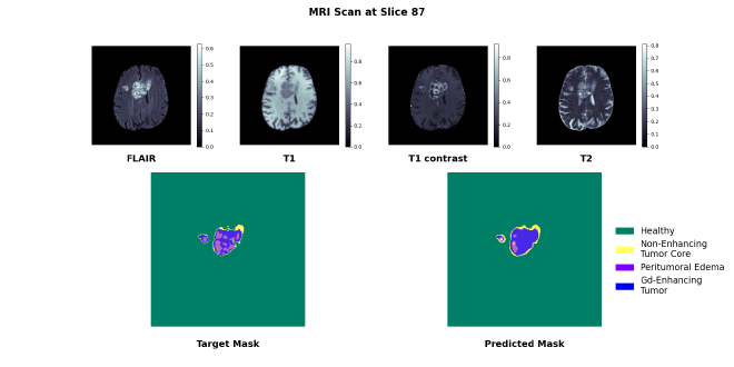 MRI cross-section showing U-Net performance